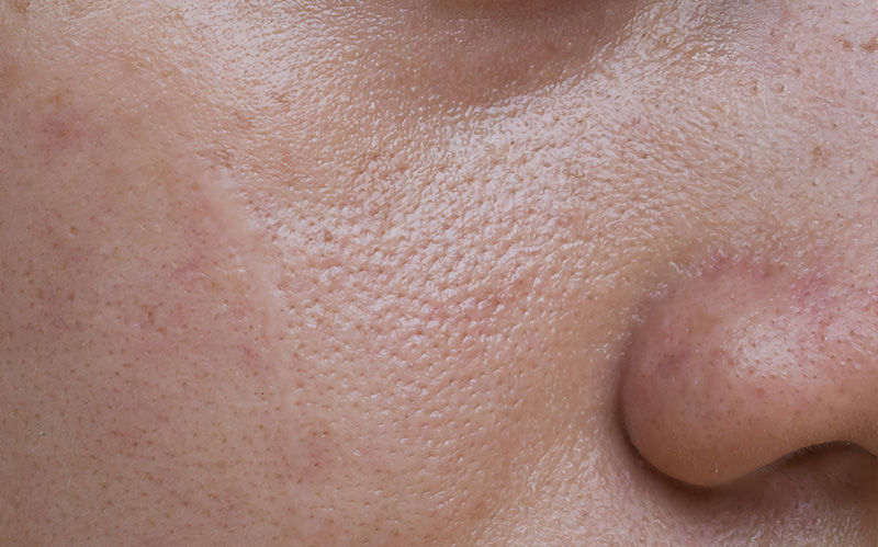 macro-view-of-enlarged-pores-and-oily-cheek-skin-texture