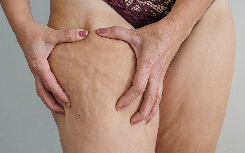 Woman-pinching-thigh-showing-visible-cellulite-before-exercise