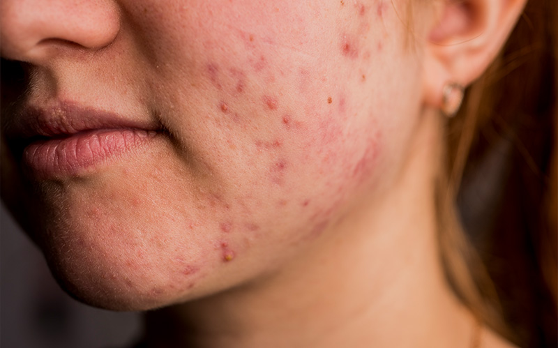 Close-up of cheek skin with active acne and post-inflammatory redness.