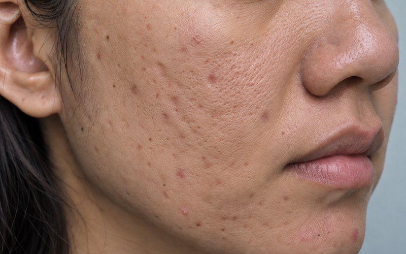 Close-up-of-woman-with-pitted-acne-scars-on-cheek