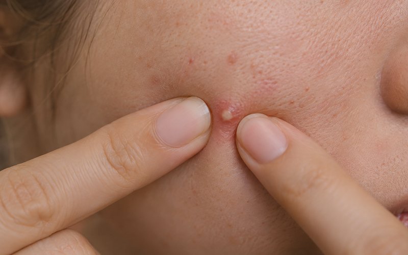 Extreme-close-up-of-a-woman-squeezing-a-pimple