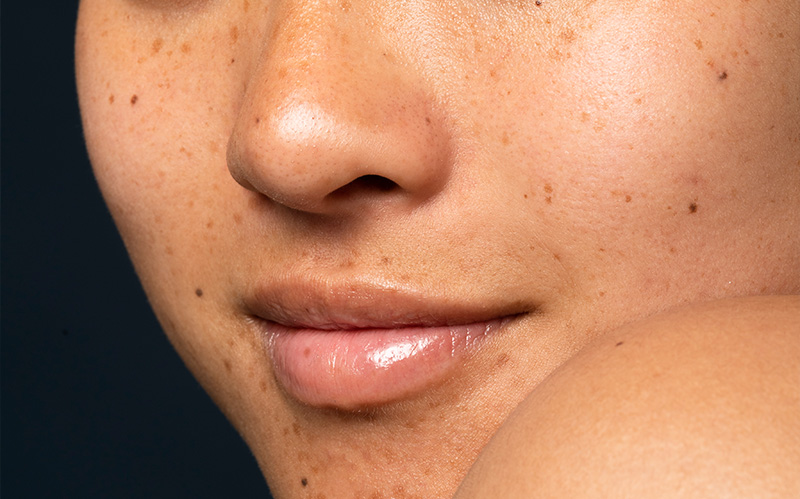 Close-up of cheek showing freckles and facial pigmentation spots.