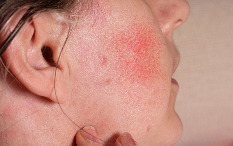 Close-up of sudden skin redness and sensitivity on cheek.